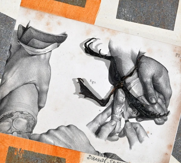 Daniel Spoerri — Collage aus der Serie "La médicine opératoire dessinée d'après nature par N.H. Jacob", 1993